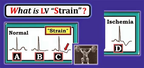 lv strain adalah